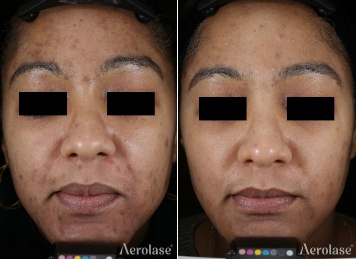 Before and after &mdash; Facial Acne Laser Therapy