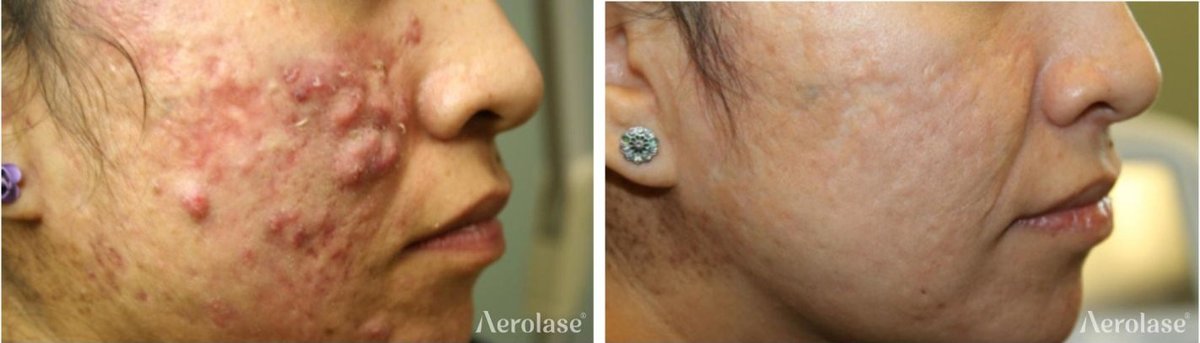 Before and after &mdash; Facial Acne Laser Therapy