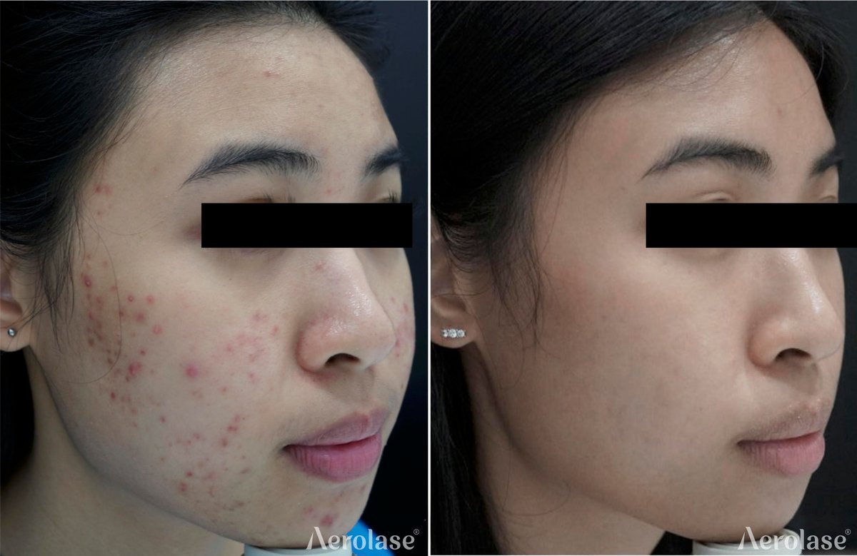 Before and after &mdash; Facial Acne Laser Therapy