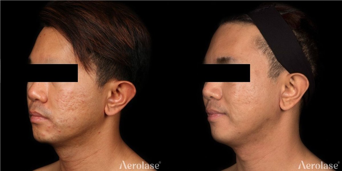 Before and after &mdash; Acne Scar Revision