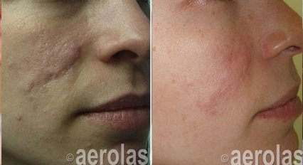 Before and after &mdash; Acne Scar Revision