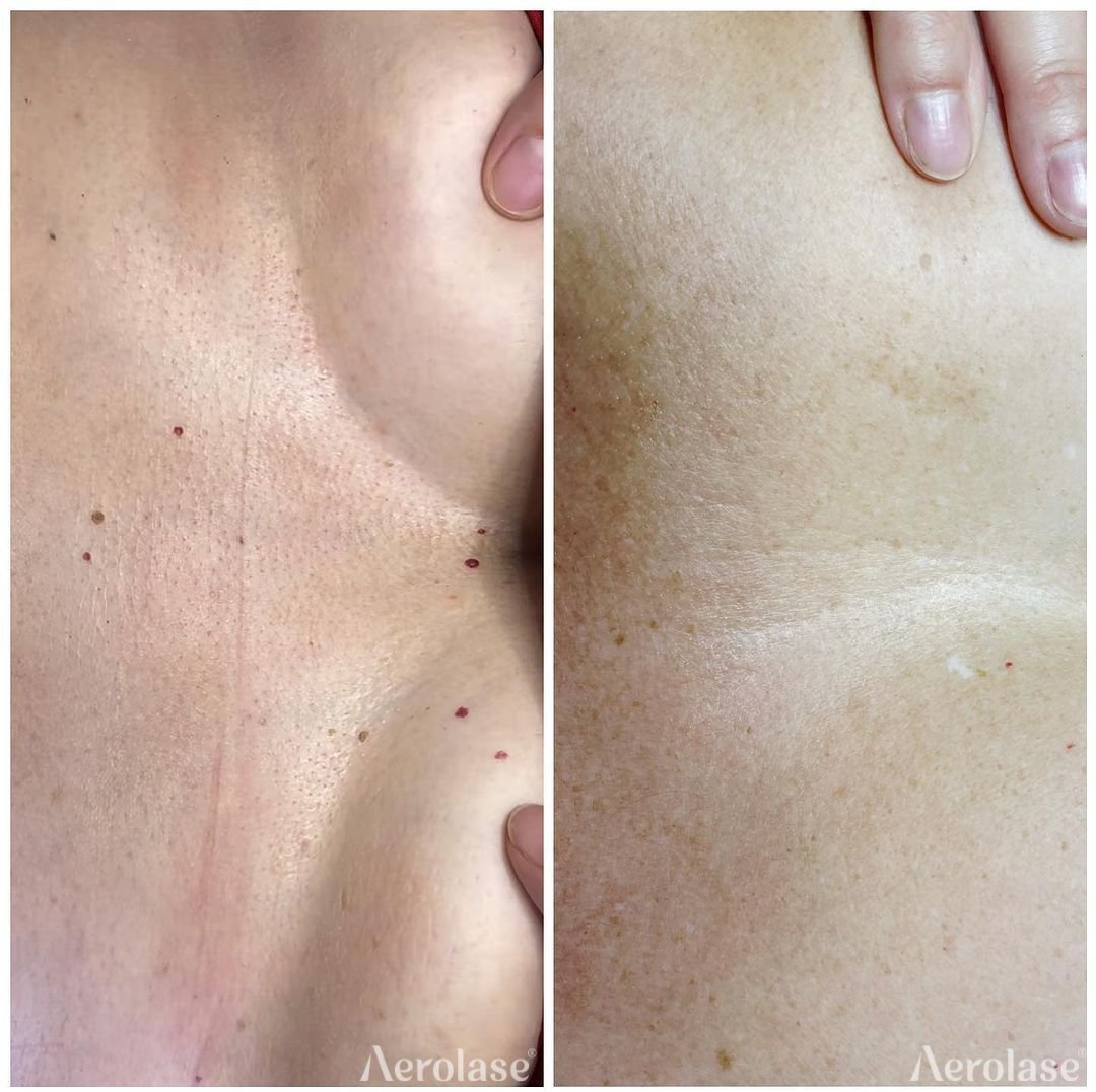 Before and after &mdash; Angioma Laser Therapy