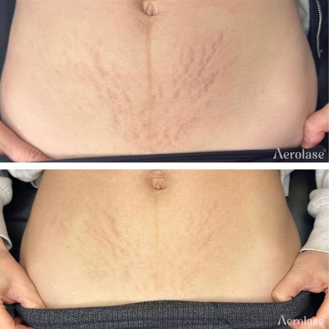 Before and after &mdash; Body Scar and Striae Revision