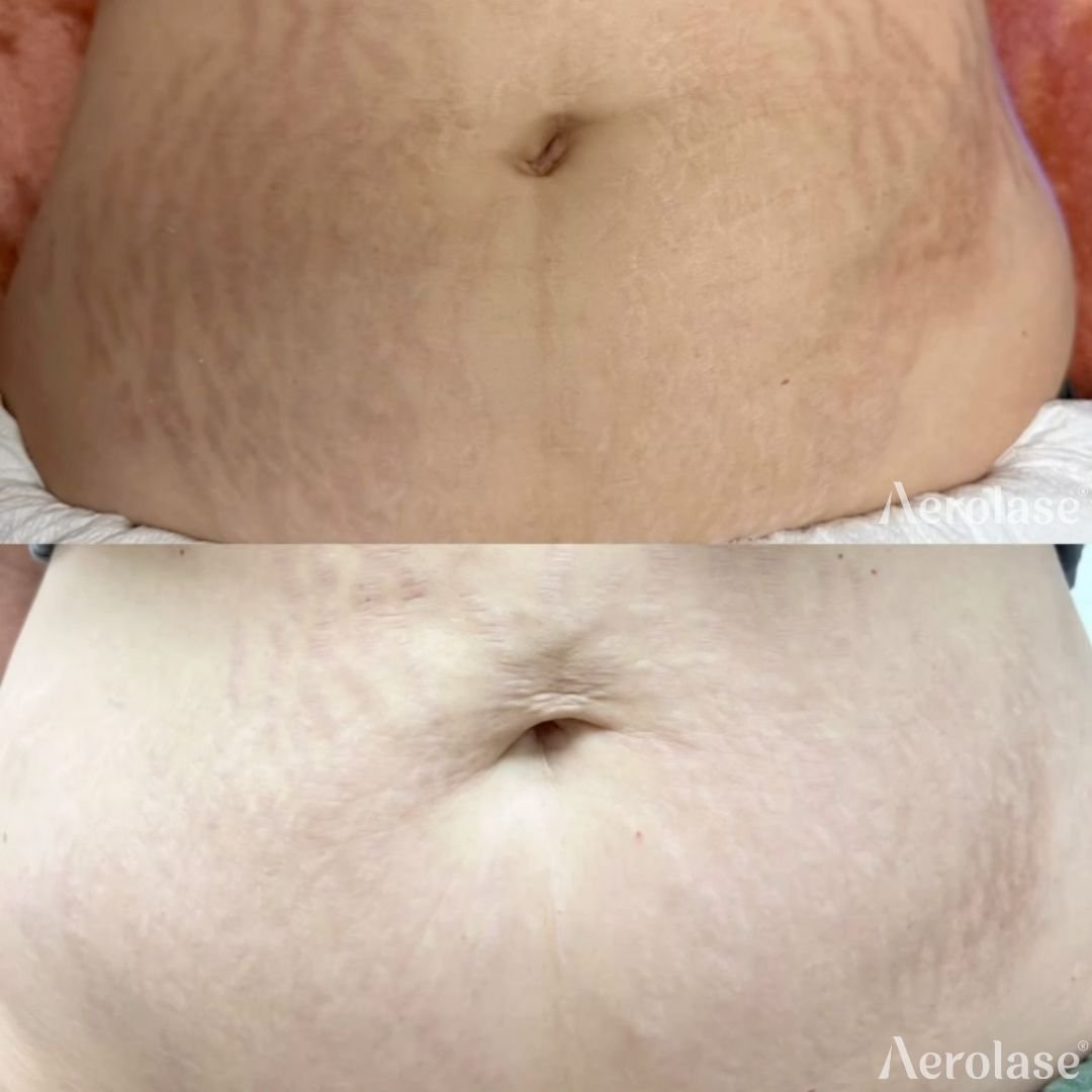 Before and after &mdash; Body Scar and Striae Revision