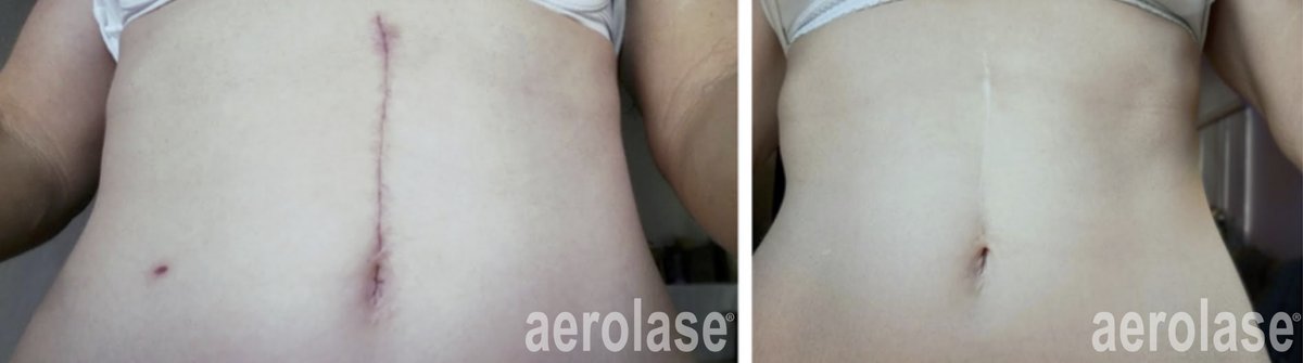 Before and after &mdash; Body Scar and Striae Revision