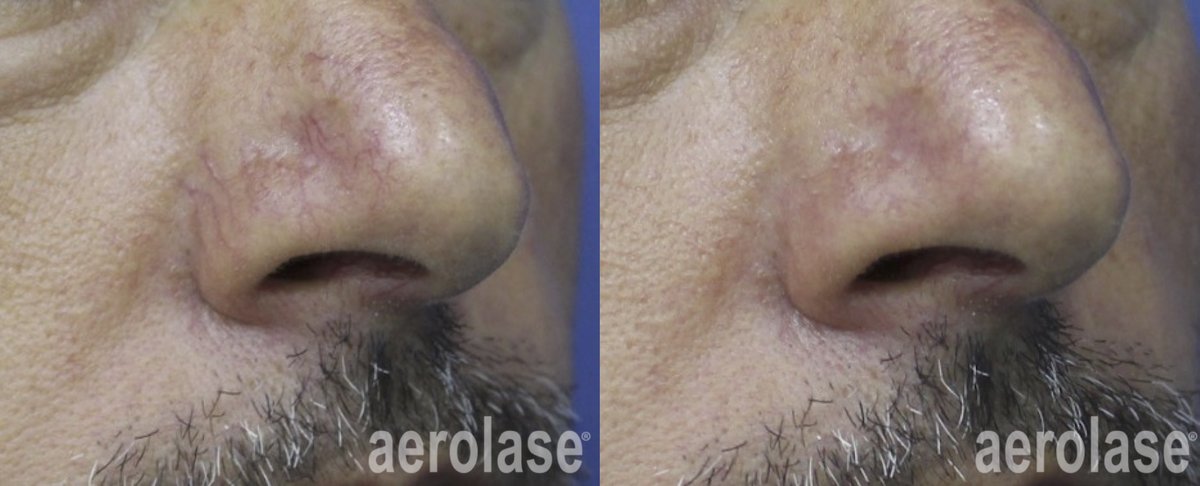 Before and after &mdash; Facial Vein and Redness Laser Therapy