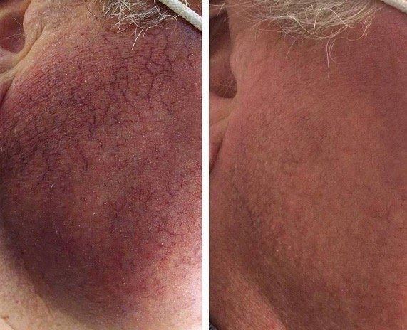 Before and after &mdash; Facial Vein and Redness Laser Therapy