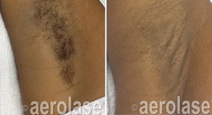Before and after &mdash; Laser Hair Removal Medium Area