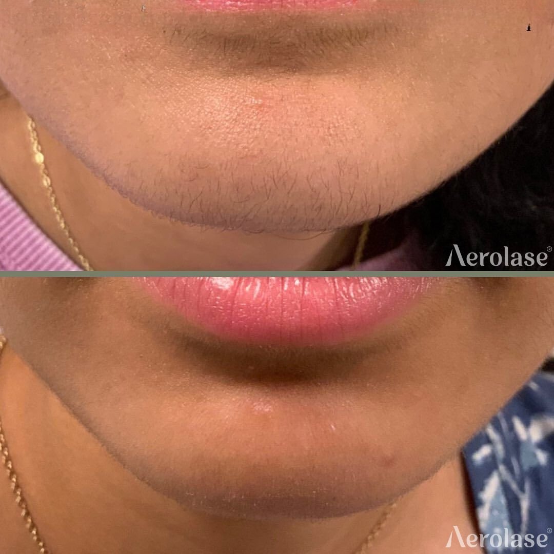 Before and after &mdash; Laser Hair Removal Small Area