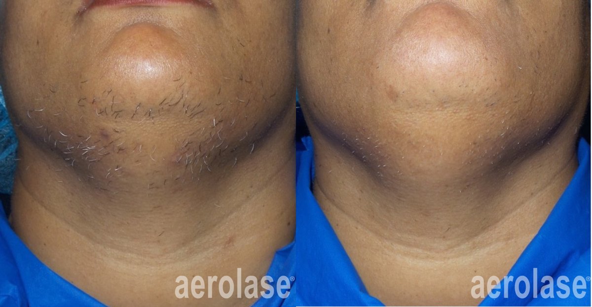 Before and after &mdash; Laser Hair Removal Small Area