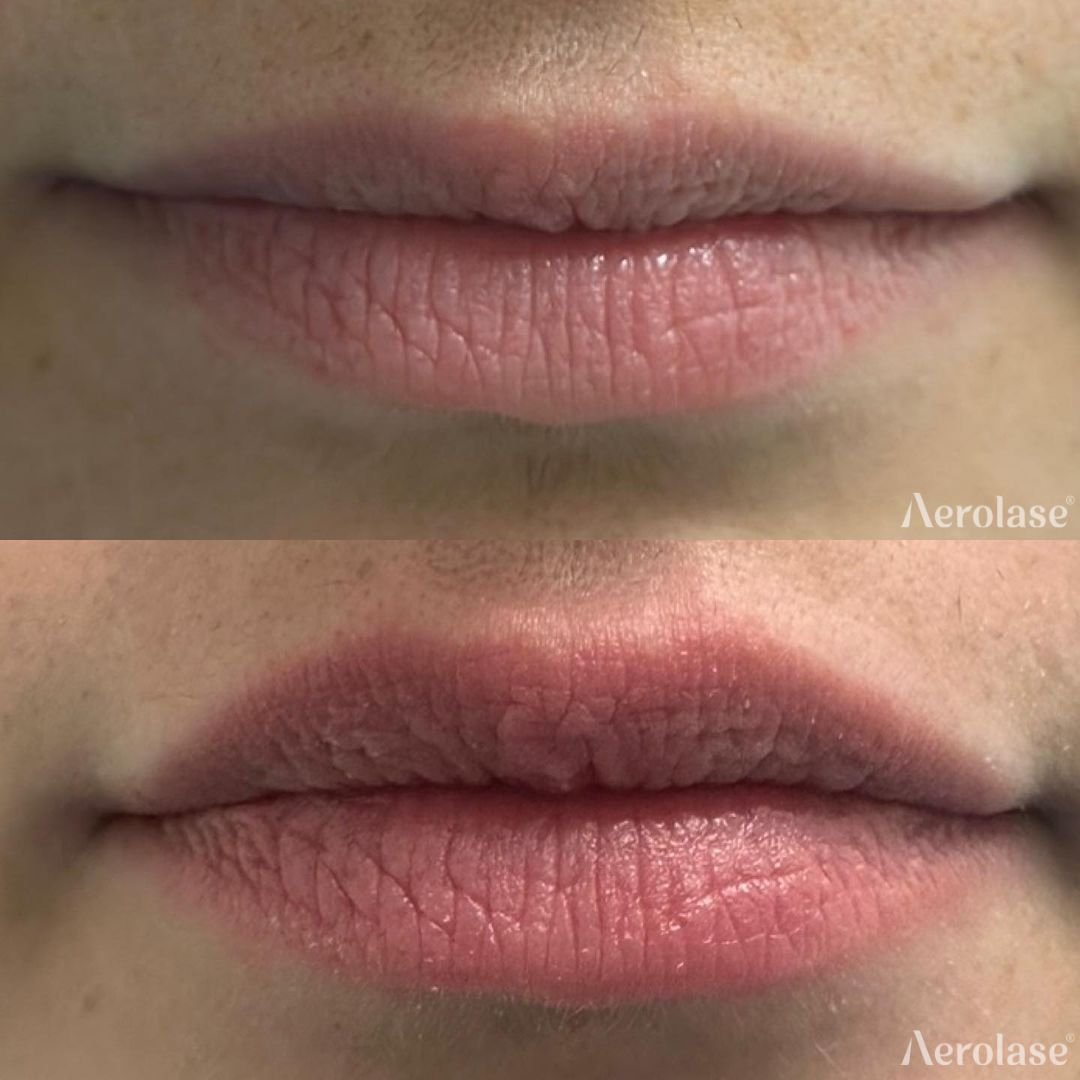 Before and after &mdash; Lip and Peri-Oral Laser Rejuvenation