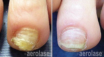 Before and after &mdash; Nail Fungus Laser Treatment