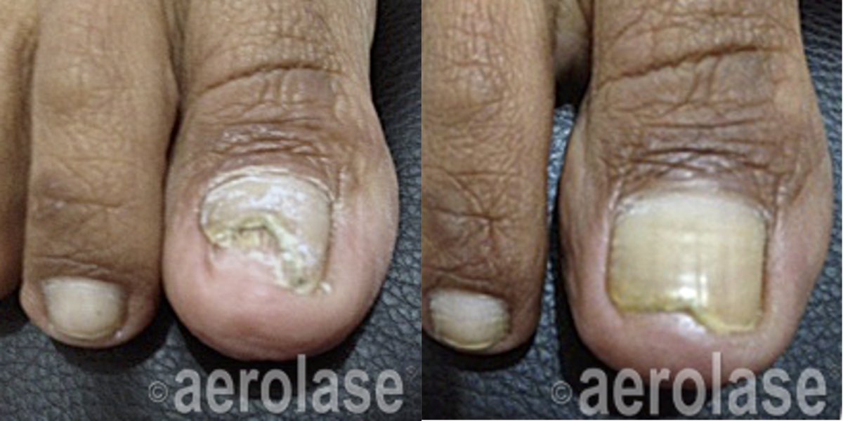 Before and after &mdash; Nail Fungus Laser Treatment