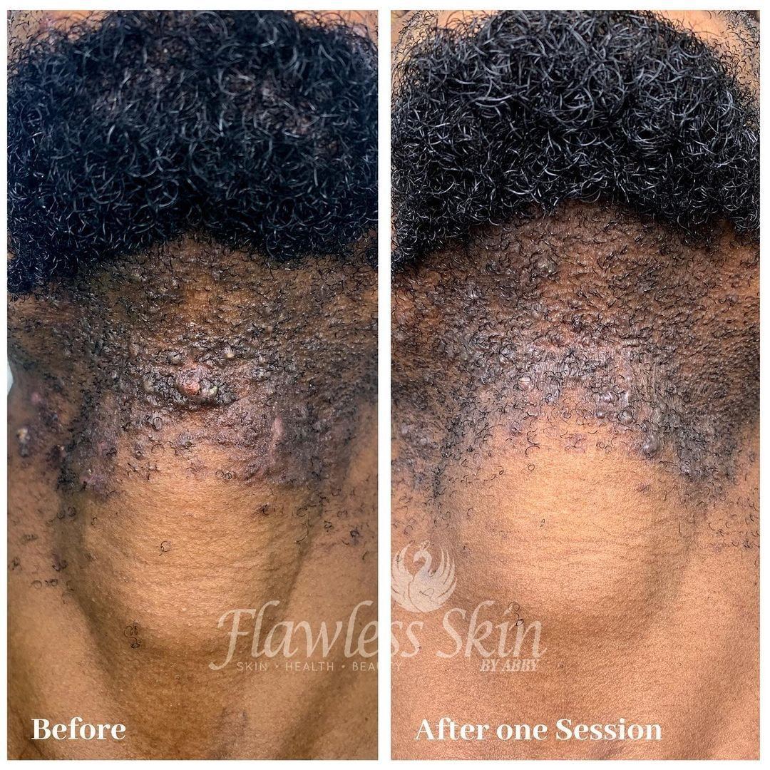 Before and after &mdash; Ingrown Hair and Razor Bump Laser Therapy