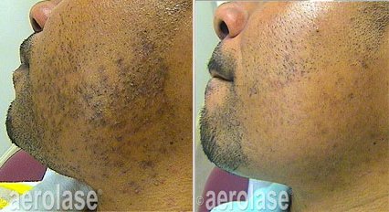Before and after &mdash; Ingrown Hair and Razor Bump Laser Therapy