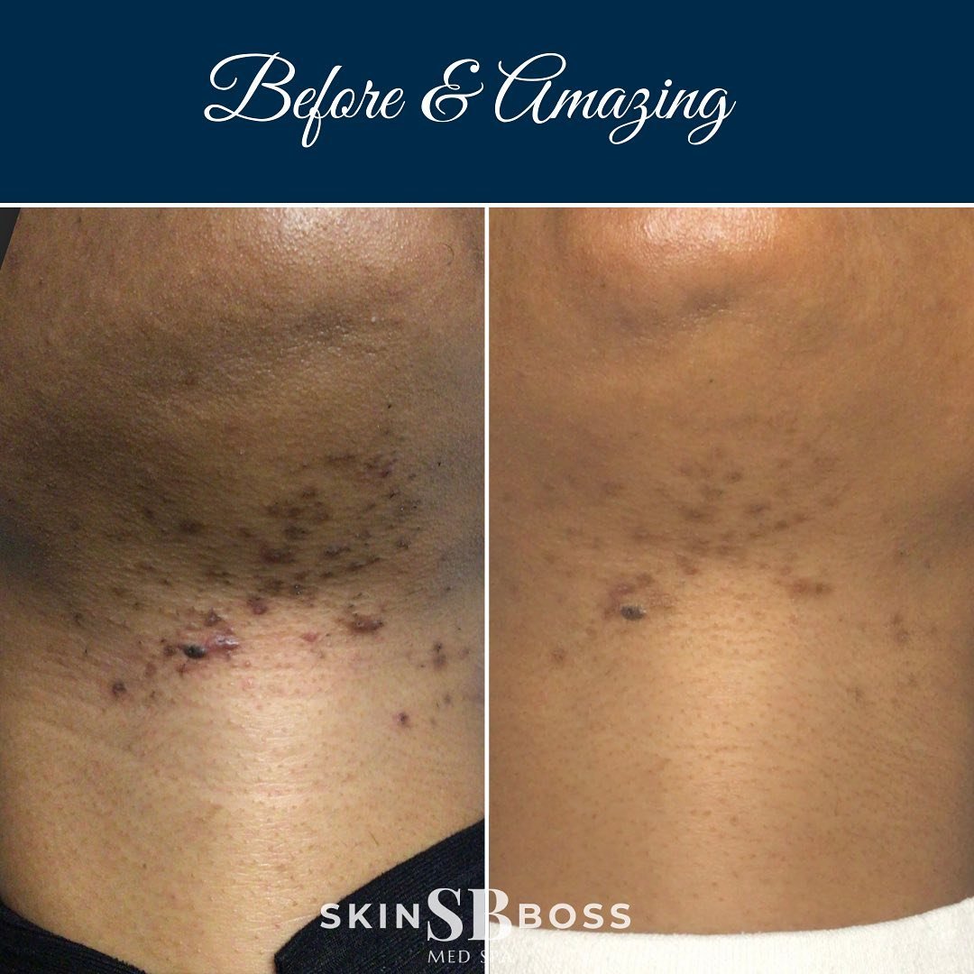 Before and after &mdash; Ingrown Hair and Razor Bump Laser Therapy