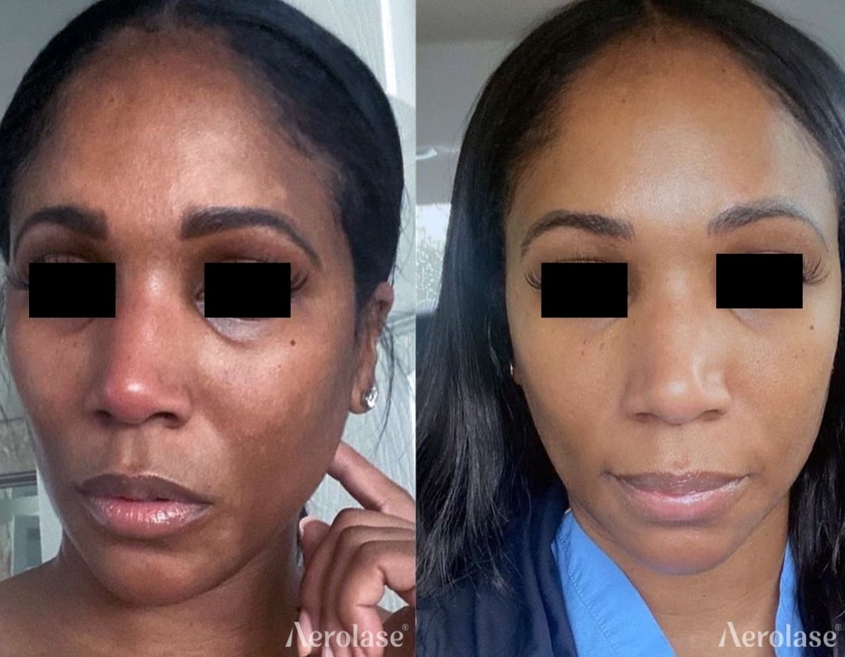 Before and after &mdash; Pigmentation Laser Correction