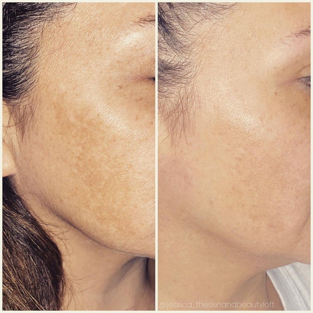 Before and after &mdash; Pigmentation Laser Correction