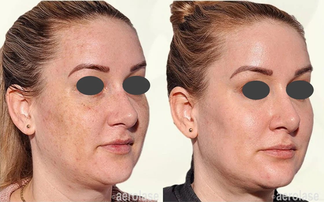 Before and after &mdash; Pigmentation Laser Correction