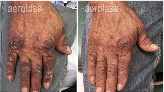Before and after &mdash; Psoriasis and Eczema Laser Therapy