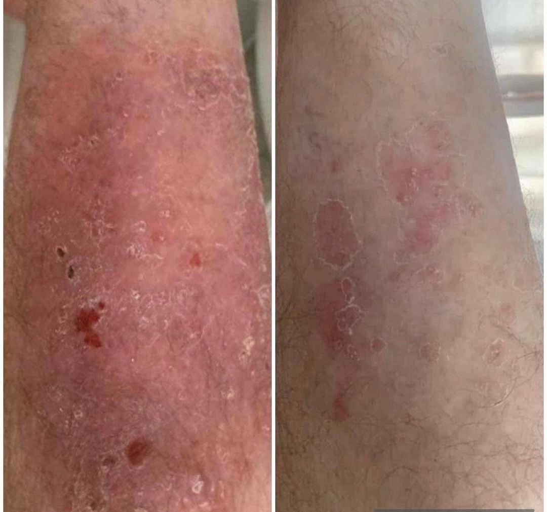 Before and after &mdash; Psoriasis and Eczema Laser Therapy