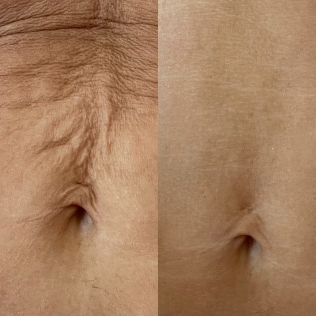Before and after &mdash; Body Skin Laser Rejuvenation and Tightening