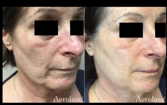 Before and after &mdash; Face Laser Skin Rejuvenation