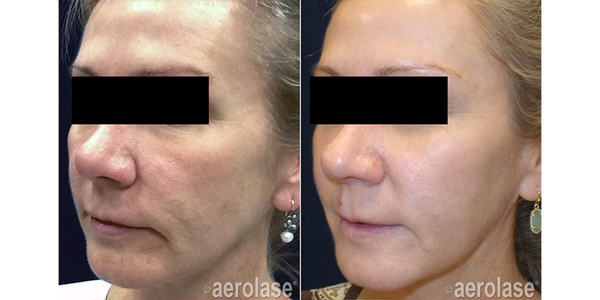 Before and after &mdash; Face Laser Skin Rejuvenation