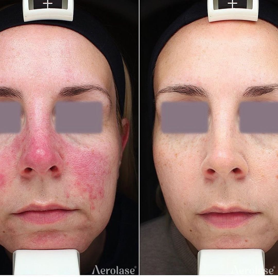 Before and after &mdash; Rosacea Laser Therapy