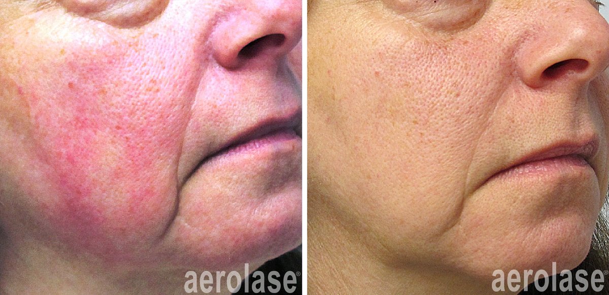 Before and after &mdash; Rosacea Laser Therapy