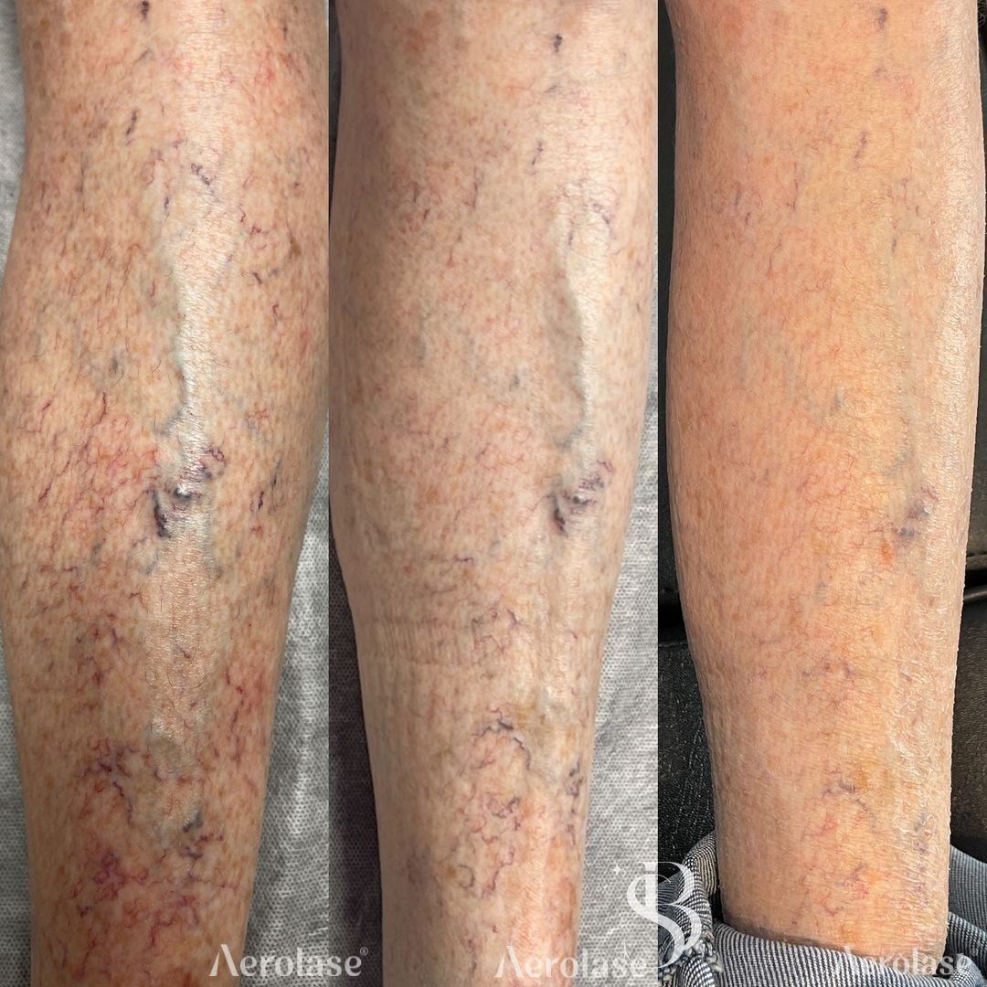 Before and after &mdash; Body Spider Vein Laser Therapy