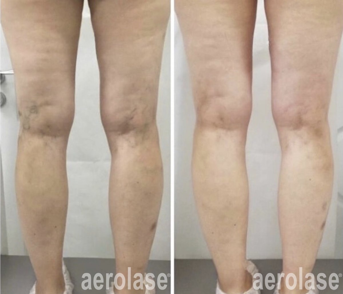 Before and after &mdash; Body Spider Vein Laser Therapy
