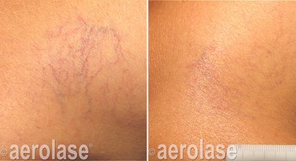 Before and after &mdash; Body Spider Vein Laser Therapy