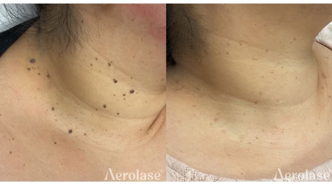 Before and after &mdash; Warts and Skin Tags Laser Therapy