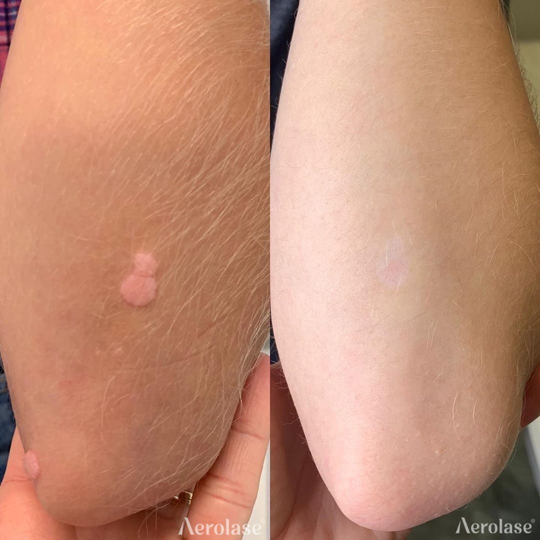 Before and after &mdash; Warts and Skin Tags Laser Therapy
