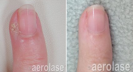 Before and after &mdash; Warts and Skin Tags Laser Therapy